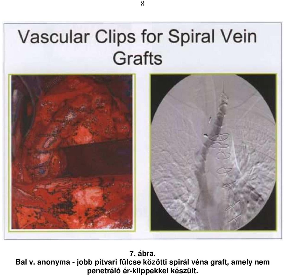közötti spirál véna graft,
