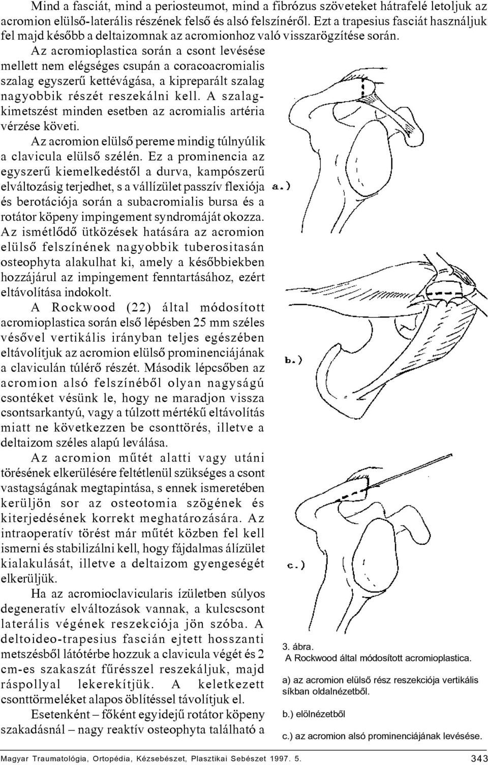 Az acromioplastica során a csont levésése mellett nem elégséges csupán a coracoacromialis szalag egyszerû kettévágása, a kipreparált szalag nagyobbik részét reszekálni kell.