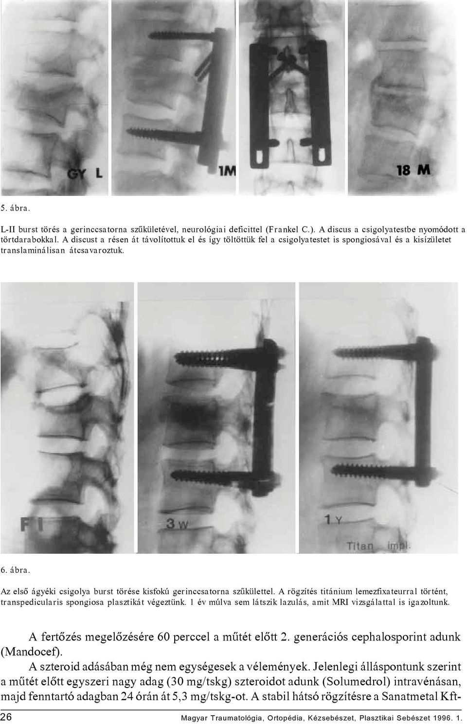 Az elsô ágyéki csigolya burst törése kisfokú gerinccsatorna szûkülettel. A rögzítés titánium lemezfixateurral történt, transpedicularis spongiosa plasztikát végeztünk.