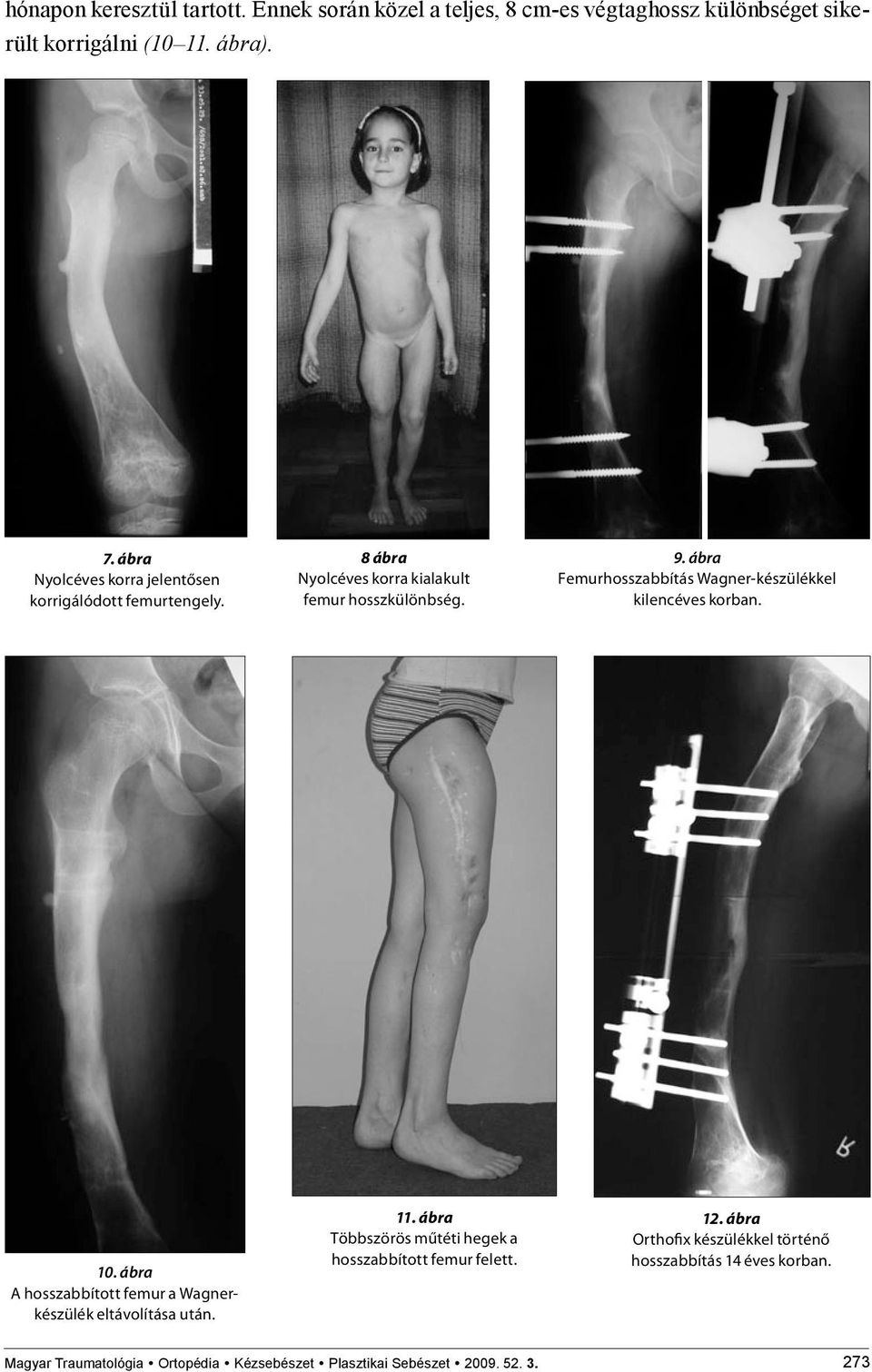 ábra Femurhosszabbítás Wagner-készülékkel kilencéves korban. 10. ábra A hosszabbított femur a Wagnerkészülék eltávolítása után. 11.