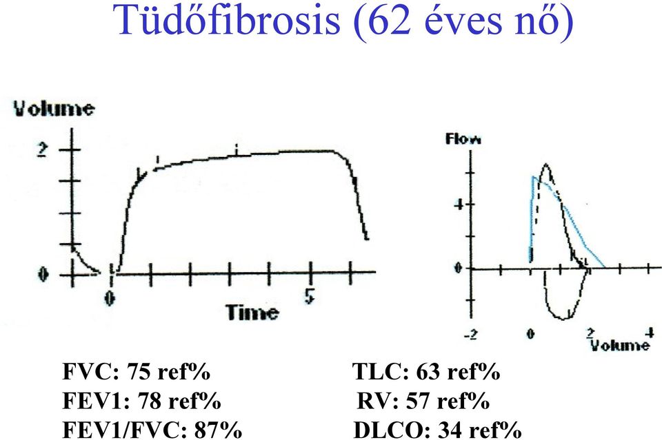 FEV1/FVC: 87% TLC: 63 ref%