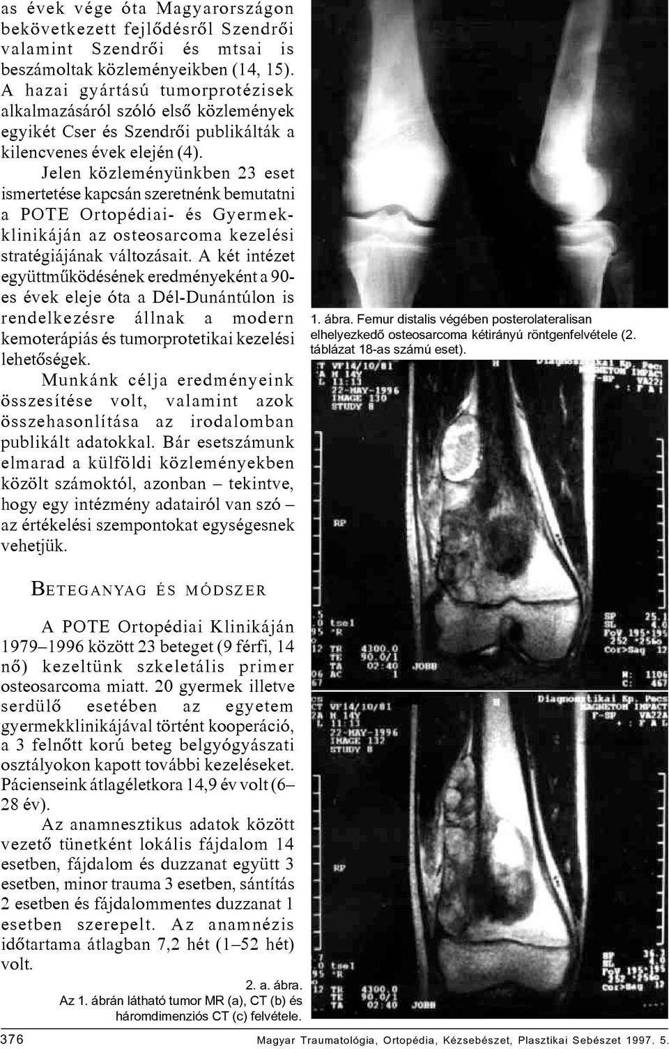 Jelen közleményünkben 23 eset ismertetése kapcsán szeretnénk bemutatni a POTE Ortopédiai- és Gyermekklinikáján az osteosarcoma kezelési stratégiájának változásait.