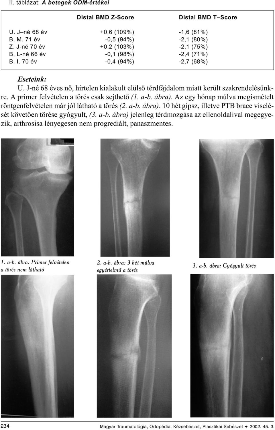 A primer felvételen a törés csak sejthetõ (1. a-b. ábra). Az egy hónap múlva megismételt röntgenfelvételen már jól látható a törés (2. a-b. ábra). 10 hét gipsz, illetve PTB brace viselését követõen törése gyógyult, (3.