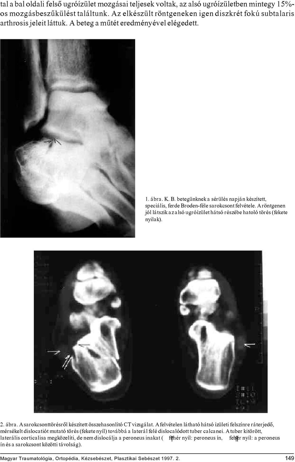 betegünknek a sérülés napján készített, speciális, ferde Broden-féle sarokcsont felvétele. A röntgenen jól látszik az alsó ugróízület hátsó részébe hatoló törés (fekete nyilak). 2. ábra.