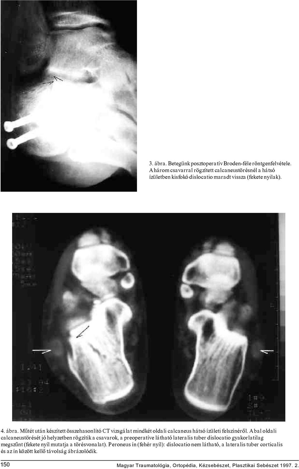 Mûtét után készített összehasonlító CT vizsgálat mindkét oldali calcaneus hátsó ízületi felszínérôl.