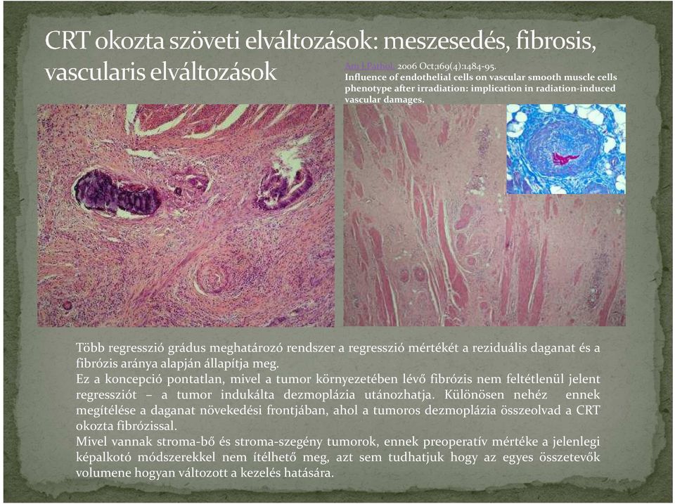 Ez a koncepció pontatlan, mivel a tumor környezetében lévő fibrózis nem feltétlenül jelent regressziót a tumor indukálta dezmoplázia utánozhatja.