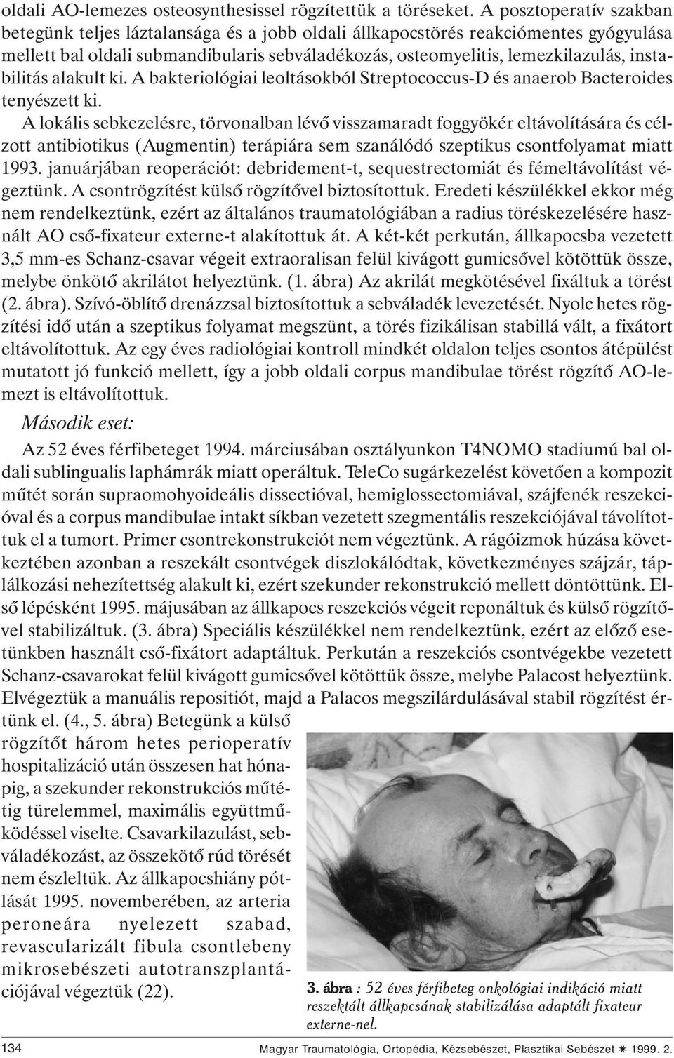 instabilitás alakult ki. A bakteriológiai leoltásokból Streptococcus-D és anaerob Bacteroides tenyészett ki.