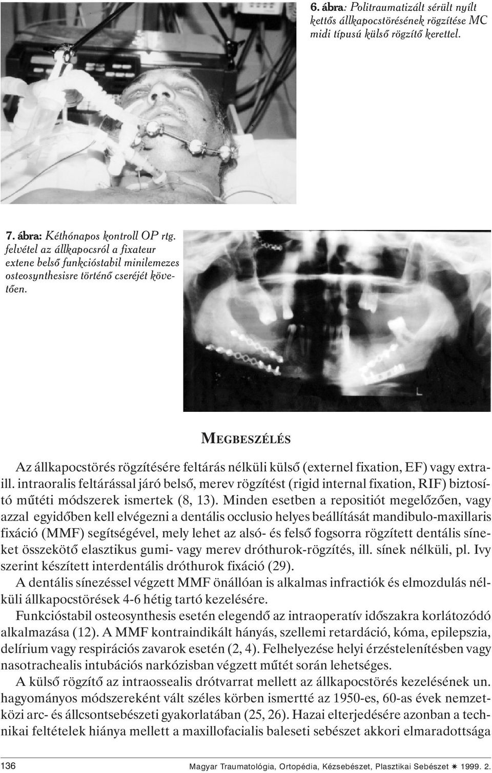 MEGBESZÉLÉS Az állkapocstörés rögzítésére feltárás nélküli külsô (externel fixation, EF) vagy extraill.