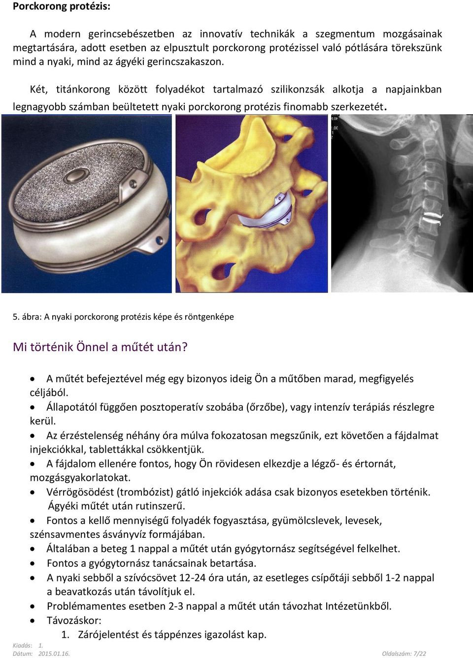 ábra: A nyaki porckorong protézis képe és röntgenképe Mi történik Önnel a műtét után? A műtét befejeztével még egy bizonyos ideig Ön a műtőben marad, megfigyelés céljából.