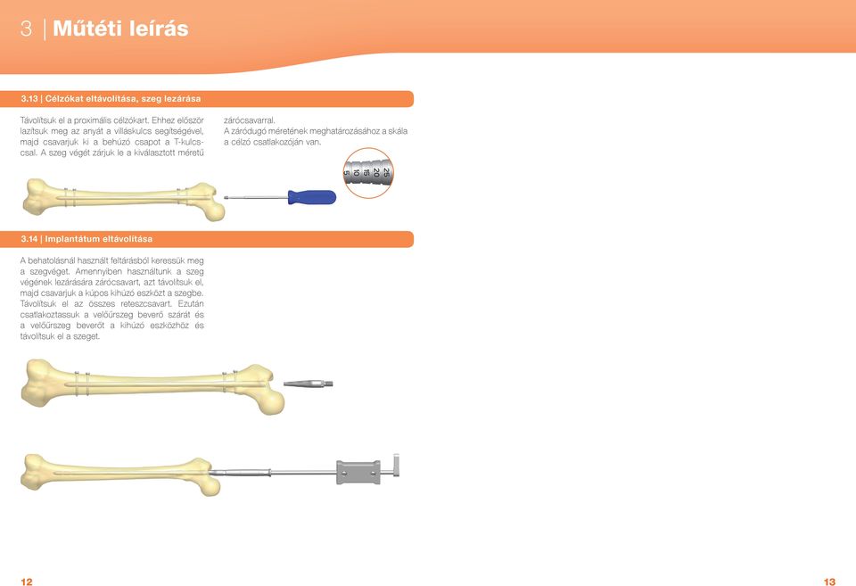 A záródugó méretének meghatározásához a skála a célzó csatlakozóján van. 3.1 Implantátum eltávolítása A behatolásnál használt feltárásból keressük meg a szegvéget.