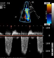 Pulmonális nyomás Bal szívfél elégtelenség esetén a számított jobb kamrai systolés nyomás jól korrelál a