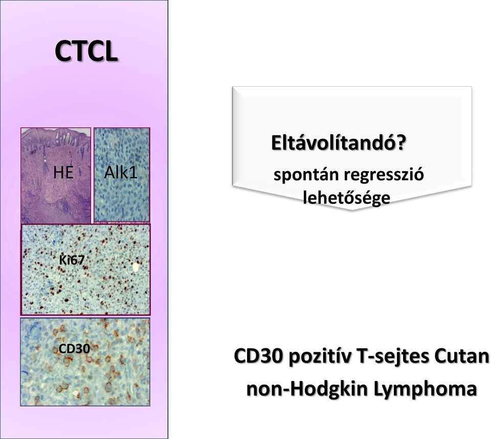 CD3 Ki67 Alk 1 CD30 CD30 pozitív