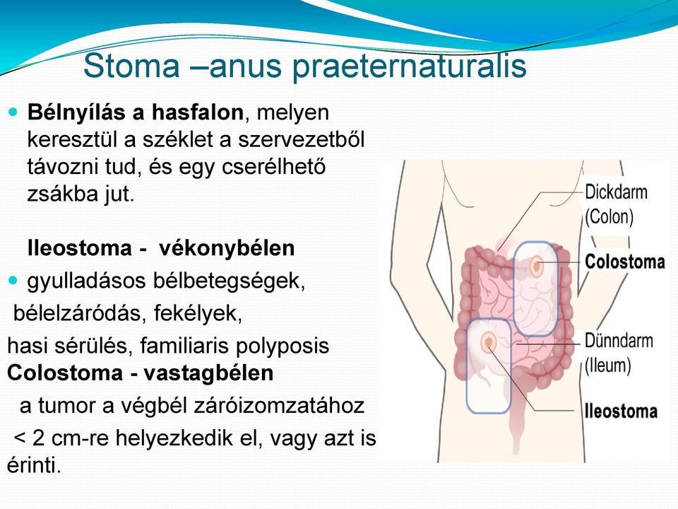 Ileostoma - vékonybélen gyulladásos bélbetegségek, bélelzáródás, fekélyek, hasi