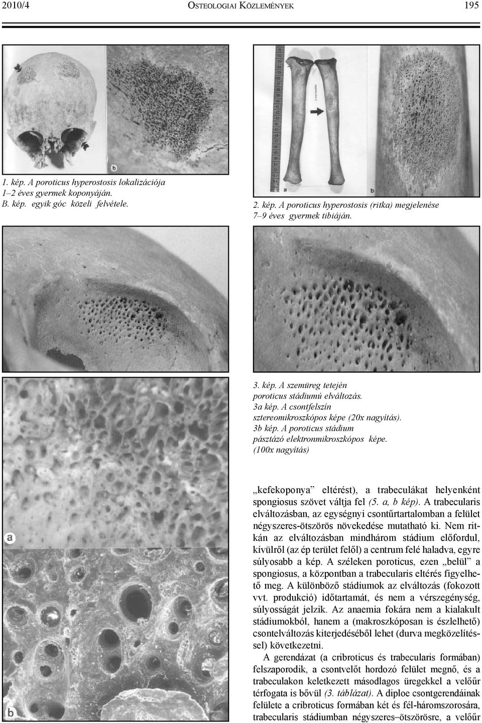 (100x nagyítás) kefekoponya eltérést), a trabeculákat helyenként spongiosus szövet váltja fel (5. a, b kép).