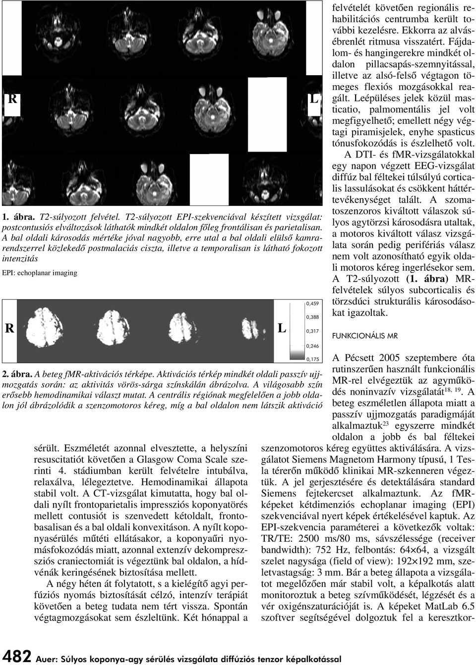 imaging R 2. ábra. A beteg fmr-aktivációs térképe. Aktivációs térkép mindkét oldali passzív ujjmozgatás során: az aktivitás vörös-sárga színskálán ábrázolva.