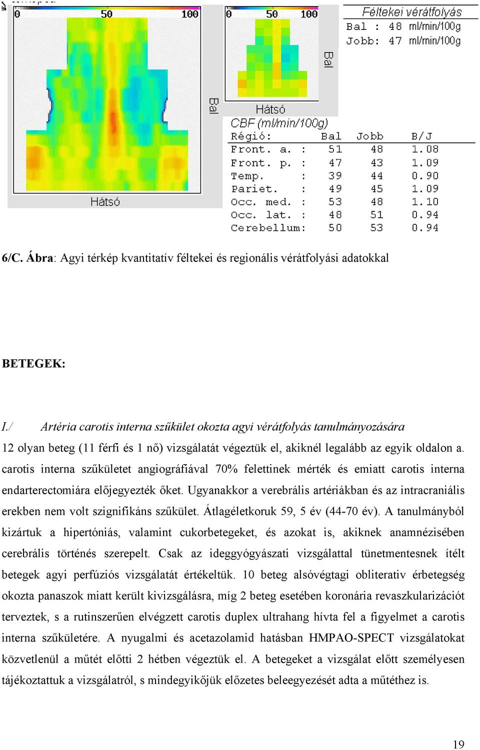 carotis interna sz kületet angiográfiával 70% felettinek mérték és emiatt carotis interna endarterectomiára el jegyezték ket.