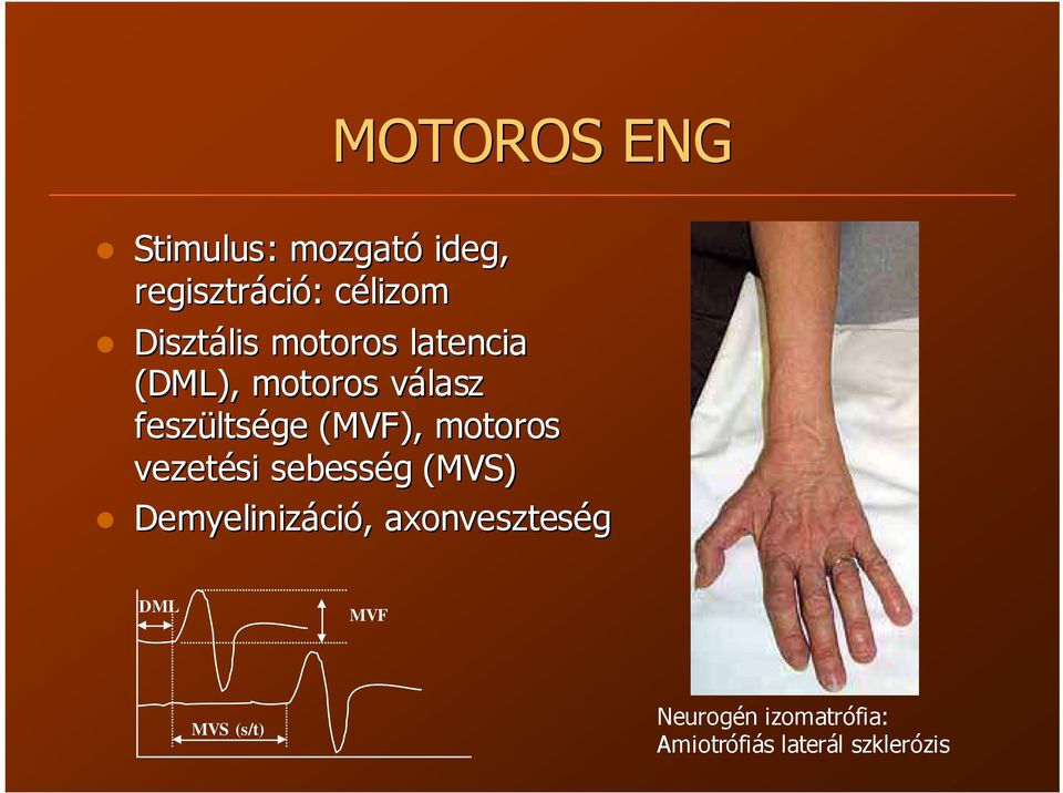(MVF), motoros vezetési sebesség g (MVS) Demyelinizáci ció, axonves
