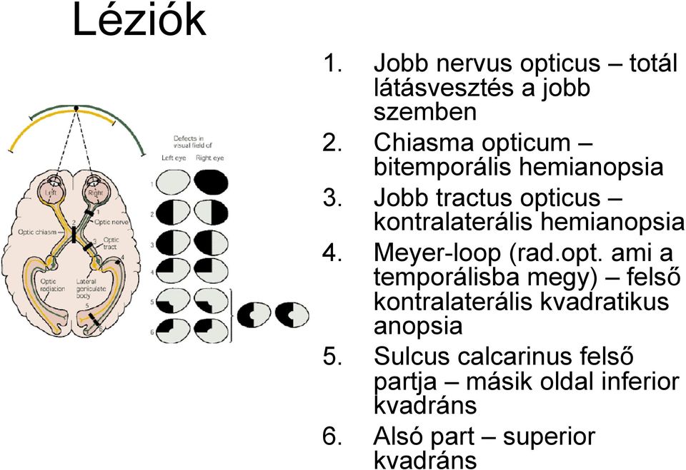 Jobb tractus opticus kontralaterális hemianopsia 4. Meyer-loop (rad.opt. ami a temporálisba megy) felső kontralaterális kvadratikus anopsia 5.