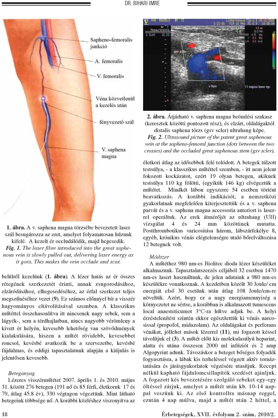 The laser fibre introduced into the great saphenous vein is slowly pulled out, delivering laser energy as it goes. This makes the vein occlude and scar. belülrõl kezelünk (1. ábra).