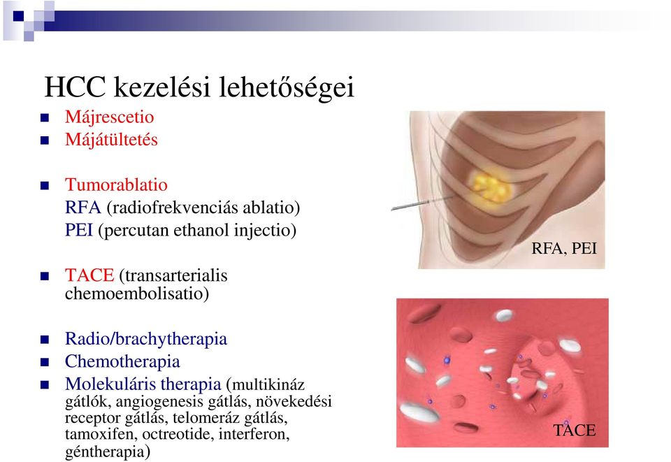 Radio/brachytherapia Chemotherapia Molekuláris therapia (multikináz gátlók, angiogenesis