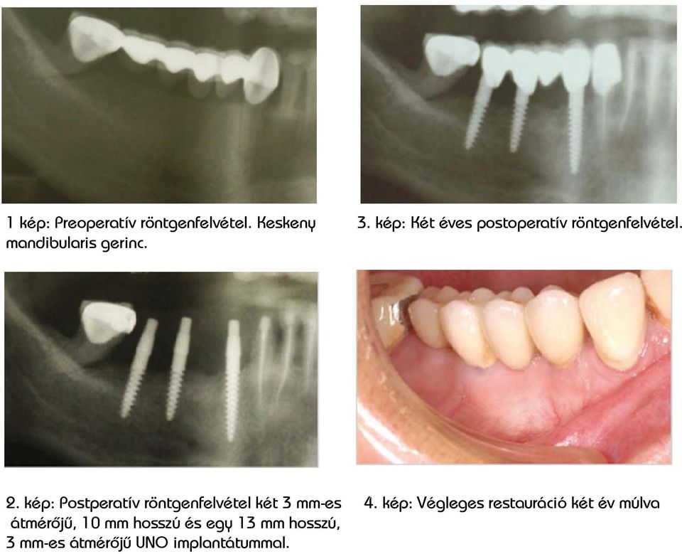 kép: Postperatív röntgenfelvétel két 3 mm-es 4.