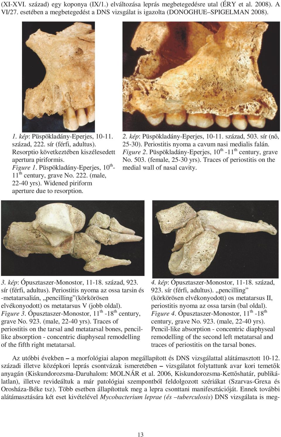 Widened piriform aperture due to resorption. 2. kép: Püspökladány-Eperjes, 10-11. század, 503. sír (nő, 25-30). Periostitis nyoma a cavum nasi medialis falán. Figure 2.