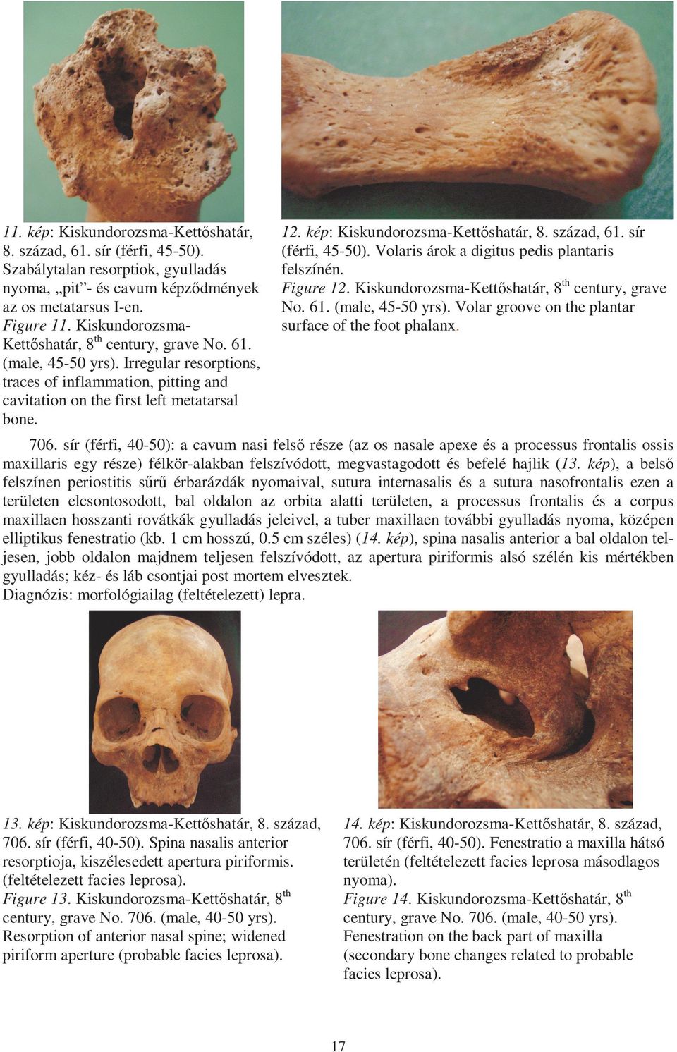 kép: Kiskundorozsma-Kettőshatár, 8. század, 61. sír (férfi, 45-50). Volaris árok a digitus pedis plantaris felszínén. Figure 12. Kiskundorozsma-Kettőshatár, 8th century, grave No. 61. (male, 45-50 yrs).