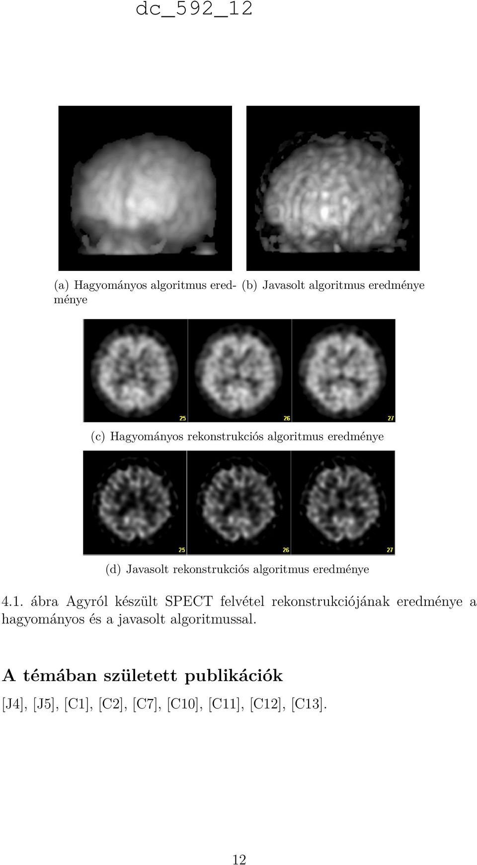 ábra Agyról készült SPECT felvétel rekonstrukciójának eredménye a hagyományos és a javasolt