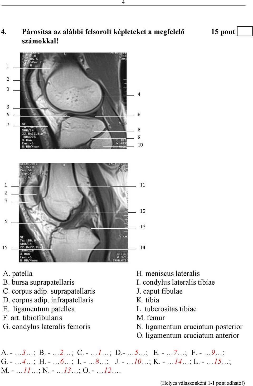 tuberositas tibiae F. art. tibiofibularis M. femur G. condylus lateralis femoris N. ligamentum cruciatum posterior O.