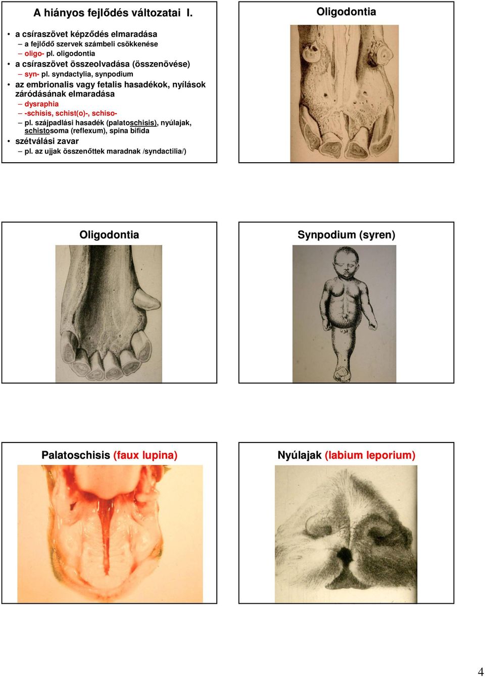 syndactylia, synpodium az embrionalis vagy fetalis hasadékok, nyílások záródásának elmaradása dysraphia -schisis, schist(o)-, schiso- pl.