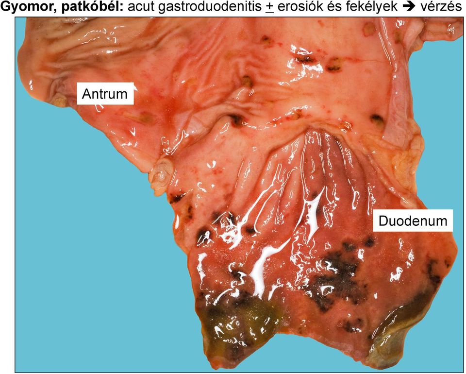 gastroduodenitis +
