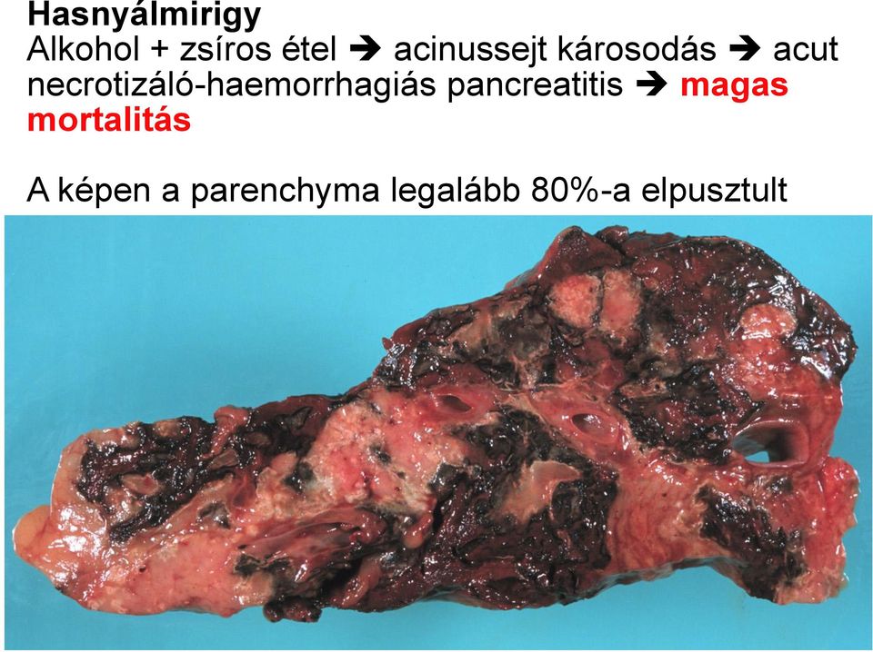 necrotizáló-haemorrhagiás pancreatitis
