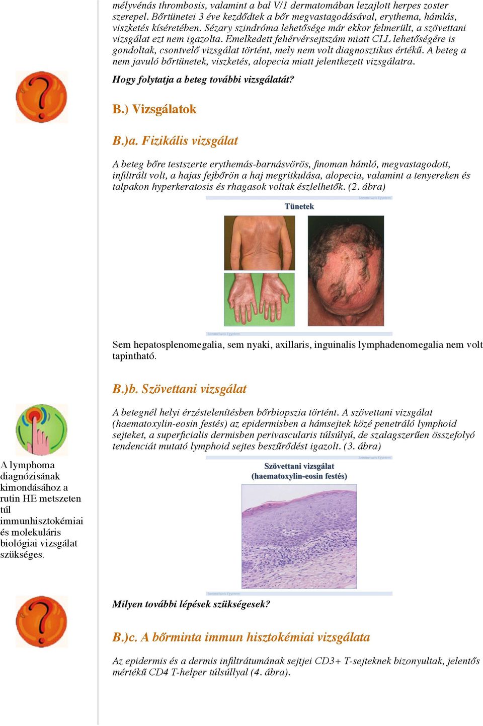 Emelkedett fehérvérsejtszám miatt CLL lehetőségére is gondoltak, csontvelő vizsgálat történt, mely nem volt diagnosztikus értékű.