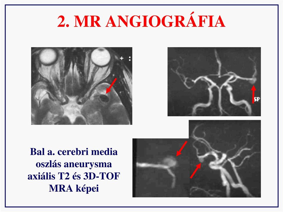 oszlás aneurysma