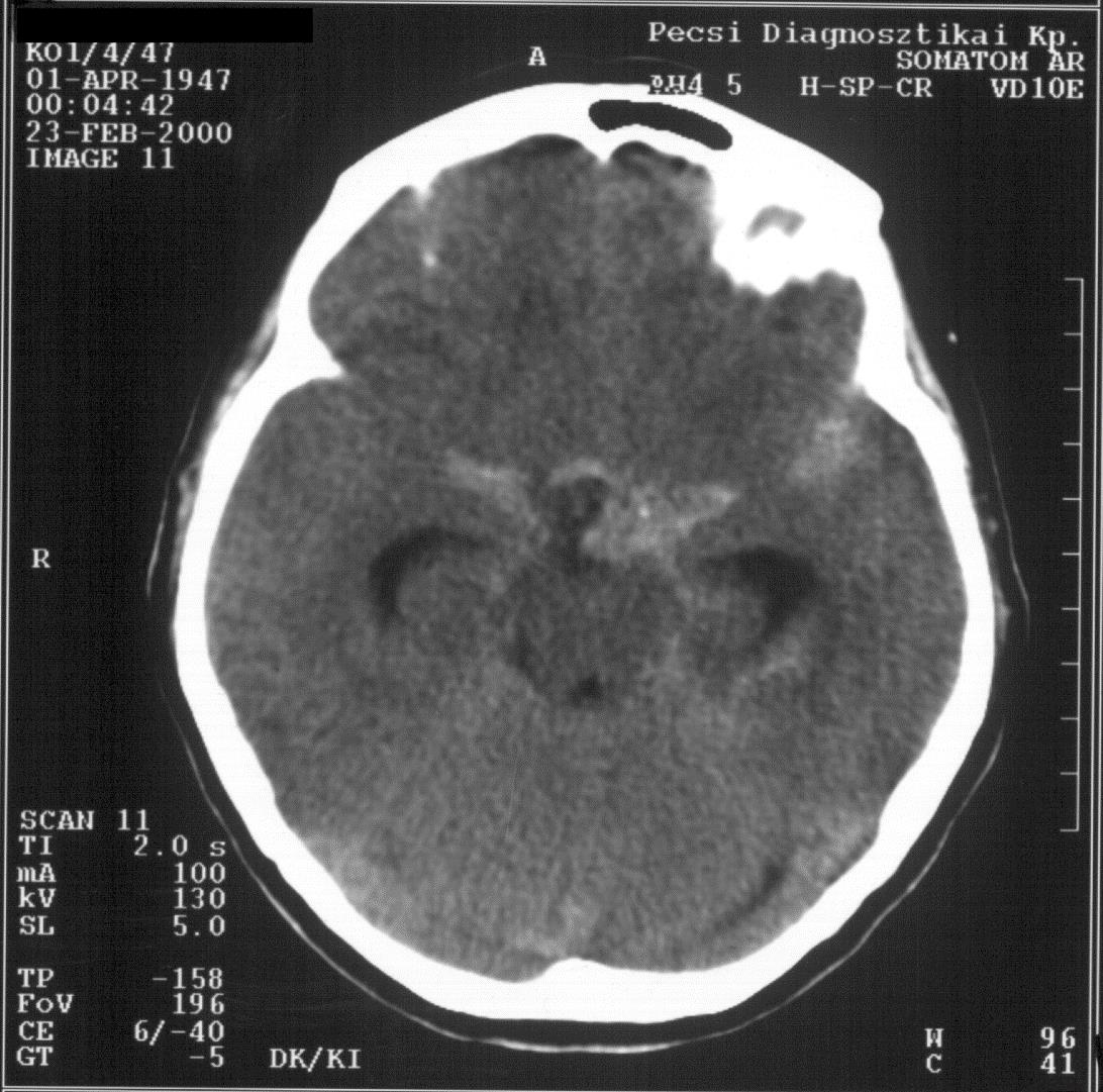 Subarachnoidalis vérzés A vérzés hyperdenz jelként jelenik meg a basalis