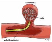 Érfejlődési rendellenességek kezelése Mikrosebészeti: elzárás Endovascularis: embolizálás (kevéssé