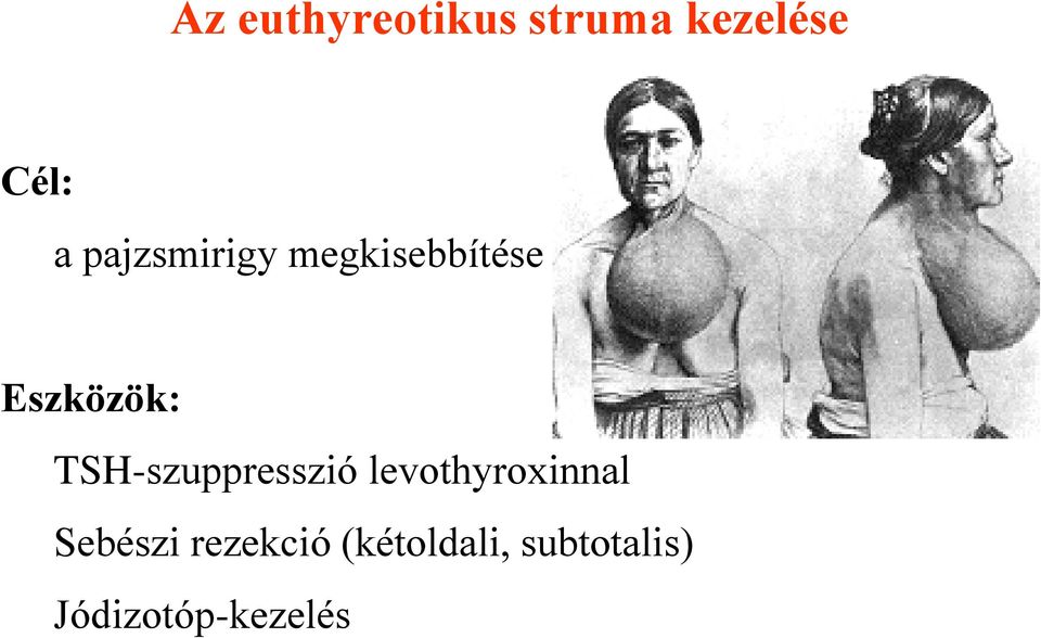 TSH-szuppresszió levothyroxinnal Sebészi