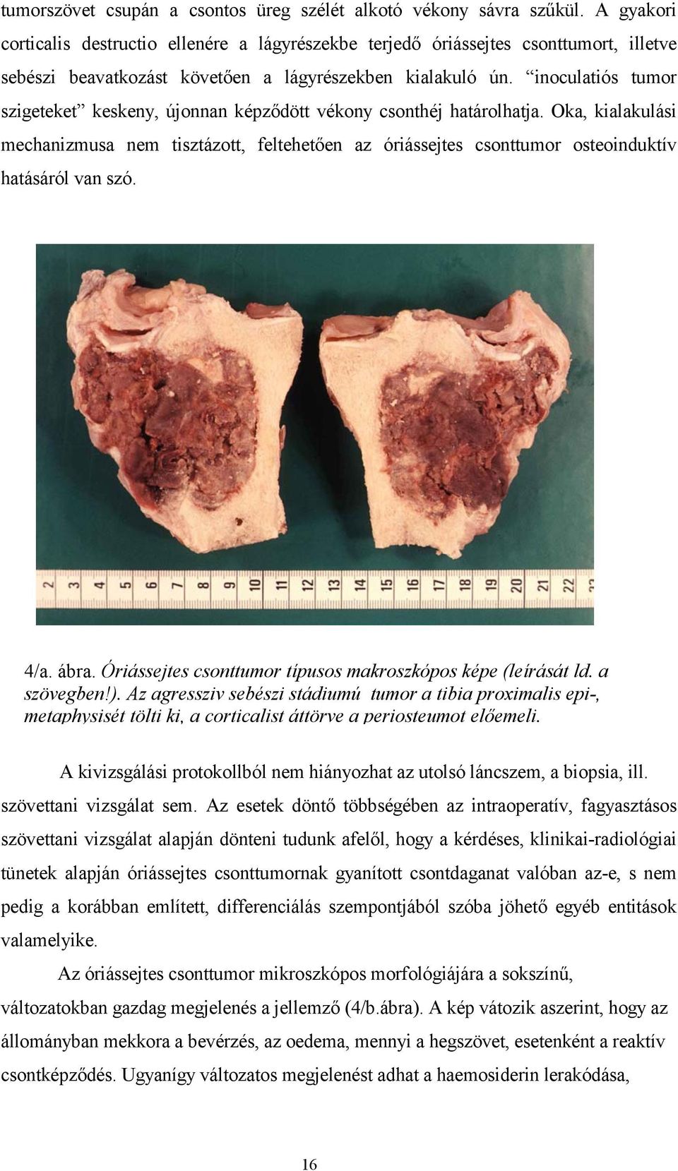 inoculatiós tumor szigeteket keskeny, újonnan képződött vékony csonthéj határolhatja.
