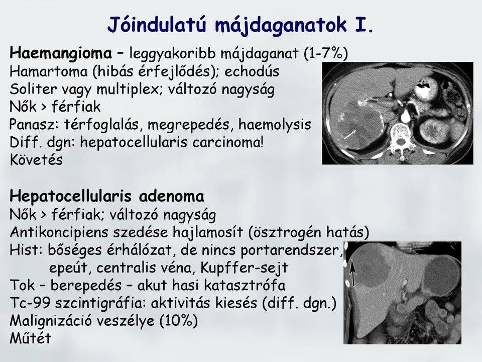 Panasz: térfoglalás, megrepedés, haemolysis Diff. dgn: hepatocellularis carcinoma!