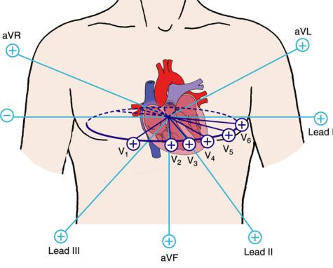 2. Az unipoláris elvezetések a végtagi (avl, avr, avf) és a mellkason elhelyezett elektródákkat (V 1 -V 6 ) az adott hely potenciálját mérik egy gyakorlatilag nulla potenciálon levő referencia