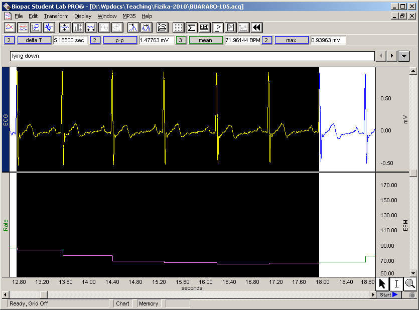 c. QRS komplexum maximális kitérését (mv) Mérőablakban P-P az ECG csatornán QRS d. Olvassa le a pulzust a vizsgált 6 szívciklusban Mérőablakban mean a Rate csatornán 6.