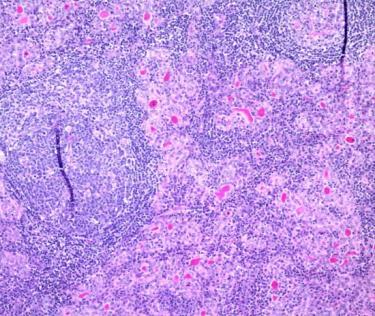 -Worrisome Histologic Alterations