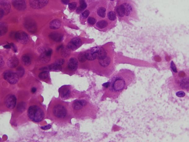 Papilláris carcinoma FNA Frozen Section of Thyroid?