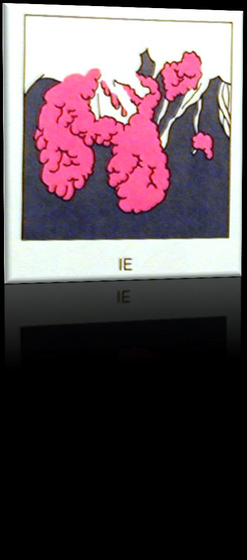 PATHOGENESIS (Endothel sérülés)
