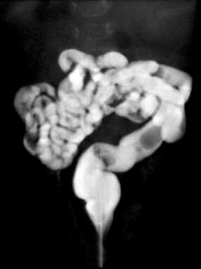 Malrotatio Felső passage vizsgálat: duodenojejunalis átmenet atipusos elhelyezkedése Passage követése: colon