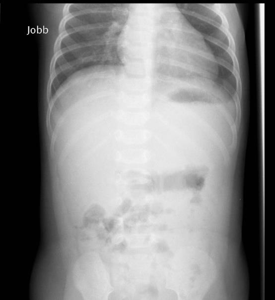 Invaginatio Akut has Ileocolicus Intermittáló hasi görcsök Málnazselé széklet (mucosa ischemiája) Ileus,