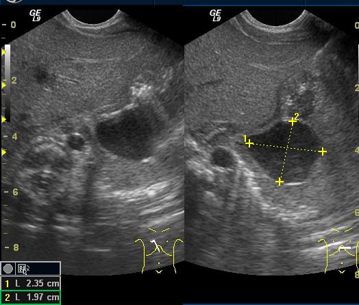 Bélduplicatura Distalis ileum,ileocoecalis billentyű,de bárhol lehet Echomentes bennékű,vastag falú,(bélfal) cysta