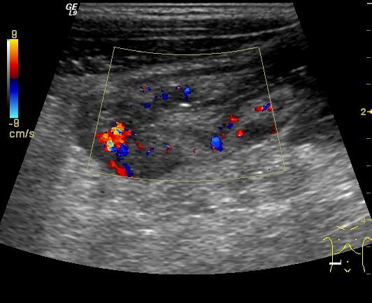Crohn - betegség Legtöbbször terminális ileum Perisztaltika hiánya, merev fal,