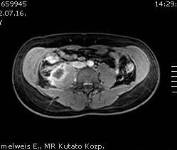 Crohn betegség ritkább