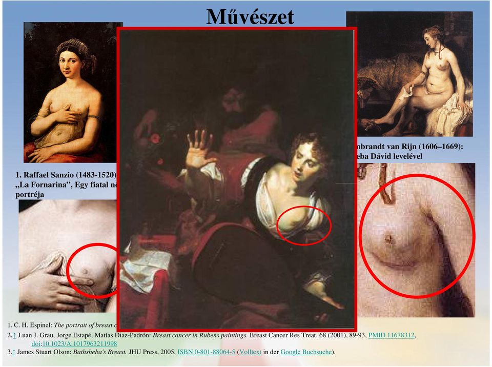 360 (2002), 2061-3, PMID 12504417 2. J.uan J. Grau, Jorge Estapé, Matías Diaz-Padrón: Breast cancer in Rubens paintings. Breast Cancer Res Treat.